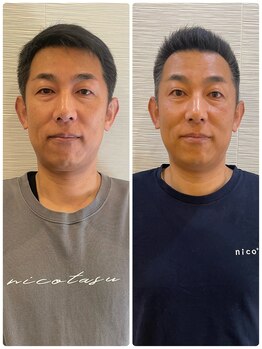 長寿鍼灸院 長寿整骨院/men's美容鍼50本効果★