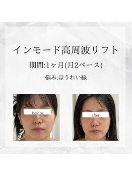 メディカルエステ 東銀座店/業界初インモード高周波リフト 