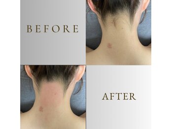 ルナソルビューティーサロン 浜松店(Lunasol)/大人気♪うなじ MIX脱毛