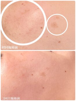 フルオール(FRUOR)/シミケア