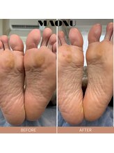 マオヌー(MAONU)/韓国式足裏角質ケア　症例写真