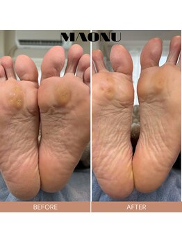 マオヌー(MAONU)/韓国式足裏角質ケア　症例写真