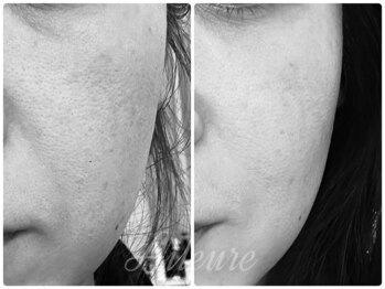 エルール トータルビューティ(Aileure total beauty)/最先端のVOSハーブピーリング