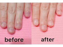 ネイル クロス ラニ 所沢店(Nail×Lani)/直せる深爪！こんなに綺麗に♪