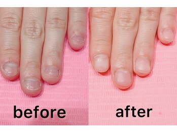 直せる深爪！こんなに綺麗に♪