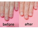 直せる深爪！こんなに綺麗に♪