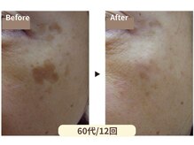 イーズサロン 西大寺店/薄くなる喜び