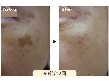 イーズサロン 西大寺店/薄くなる喜び