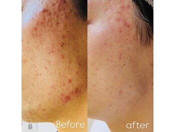 メンズエムボーテ 太田店(Men's M BEAUTE33)/【光フェイシャル×幹細胞導入】
