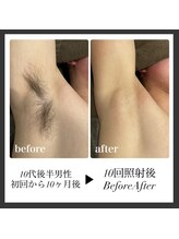 エリクサー 加須店(Elixir)/10回で3週間剃毛なし(個人差あり