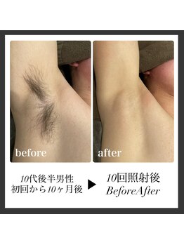 エリクサー 加須店(Elixir)/10回で3週間剃毛なし(個人差あり