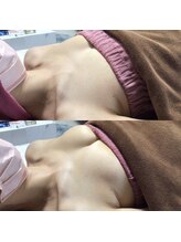 マイントゥー(mine too)/バストアップ症例