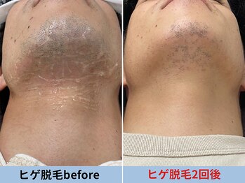 ミスターアンクール 鹿児島(Mr.uncoeur)/ヒゲ脱毛2回後