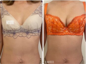 美人バスト 渋谷店/【バストアップ・育乳】症例☆