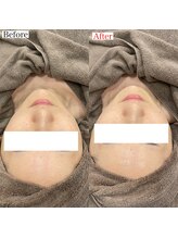 ビーブルーセブン(B.BLUE7)/【毛穴洗浄×ポレーション】