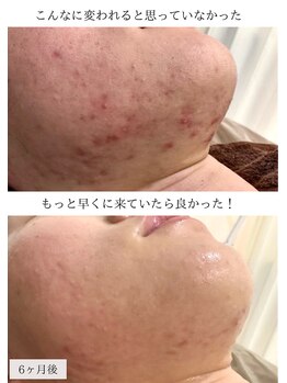 ホワイトアクア 明石店(WHITE AQUA)/ハーブピーリング/ニキビケア