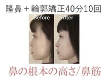 ラプリ 大阪心斎橋店(Raplit)/隆鼻＋輪郭矯正40分10回