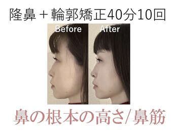 ラプリ 大阪心斎橋店(Raplit)/隆鼻＋輪郭矯正40分10回