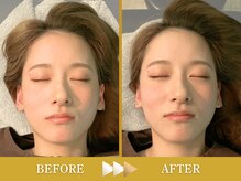 ビアンカ 目黒本院(Bianca)/歪み解消で眉毛と口角の高さ★