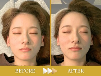 ビアンカ 目黒本院(Bianca)/歪み解消で眉毛と口角の高さ★