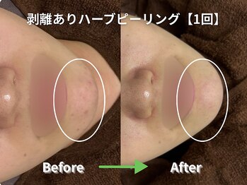 リソルバイスリール(Re:sol by sourire)/毛穴・肌質改善専門店　Re:sol