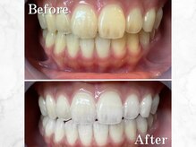 LBSホワイトニング 銀座店/セルフホワイトニングの症例写真