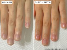 カピリナ(Ka Pilina)/自爪育成・深爪・川崎