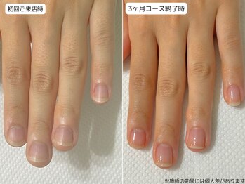 カピリナ(Ka Pilina)/自爪育成・深爪・川崎