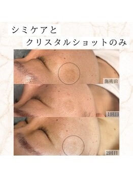 アエ(ae)/シミケアと美容液でここまで変化