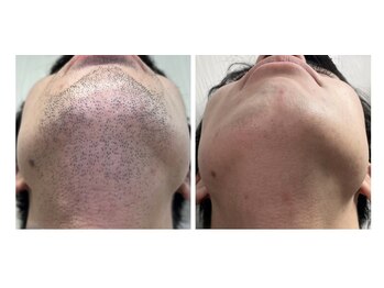 リッカ 学芸大学(RIKKA)/ひげ脱毛 ビフォーアフター