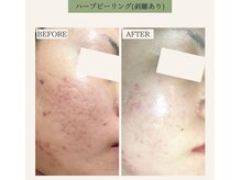 ベル 下北沢(Belle)/ハーブピーリング【ハード】