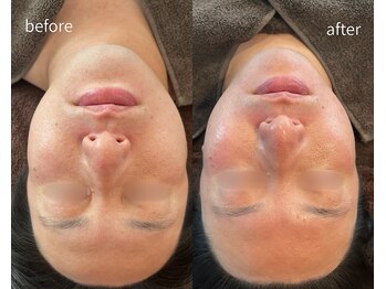 ヒミー(himee)/新感覚コルギ●小顔ウィンバック