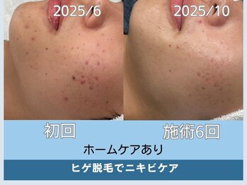 アロマ(AROMA)/ヒゲ脱毛& ニキビケア／越谷