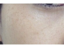 リベル 名古屋(Lebelle:)/名古屋　ハーブピーリング