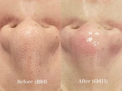 ウルト アルティメイトスキン(ULT ultimate skin)の写真