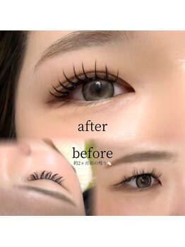 ルメ(Lum:e)/before/after