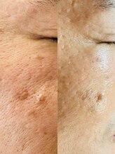 ルーク(Luke)/くすみ/たるみケア/毛穴ケア