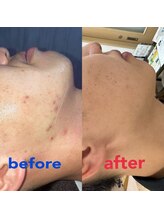 メンズ脱毛 リボーン(reborn)/肌質改善