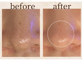 アンバー 恵比寿(AMBER)/毛穴洗浄ハイドラフェイシャル