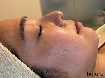 サロン ド エメ(salon de aimer)/【Before】赤み、火照るお肌に!