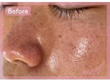 ミリ(mili)/鼻と頬の黒ずみ・頬の赤みを改善