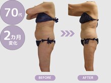 ビップ 赤坂店(Bipp!)/70代・2カ月の変化