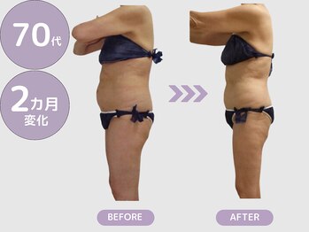 ビップ 赤坂店(Bipp!)/70代・2カ月の変化