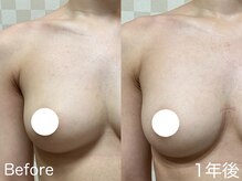 ハレオラ(HaleOla)/20代☆1年でまん丸バストに♪