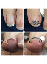 厚木 海老名 巻き爪矯正センター/事例【ツメフラ法巻き爪矯正】