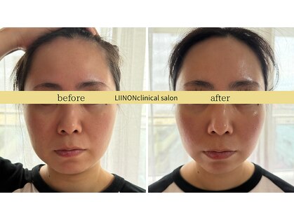 リノン(LIINON)の写真