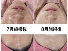 ゆらり/ニキビ・毛穴・美白ケア