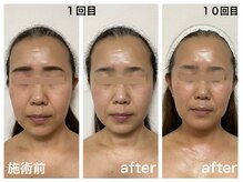 ダルセーニョ/４０代後半！「小顔サロン探し」