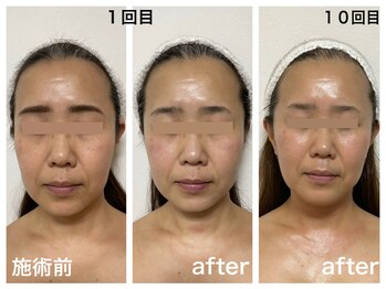 ダルセーニョ/４０代後半！「小顔サロン探し」