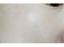 リベル 名古屋(Lebelle:)/名古屋　ハーブピーリング